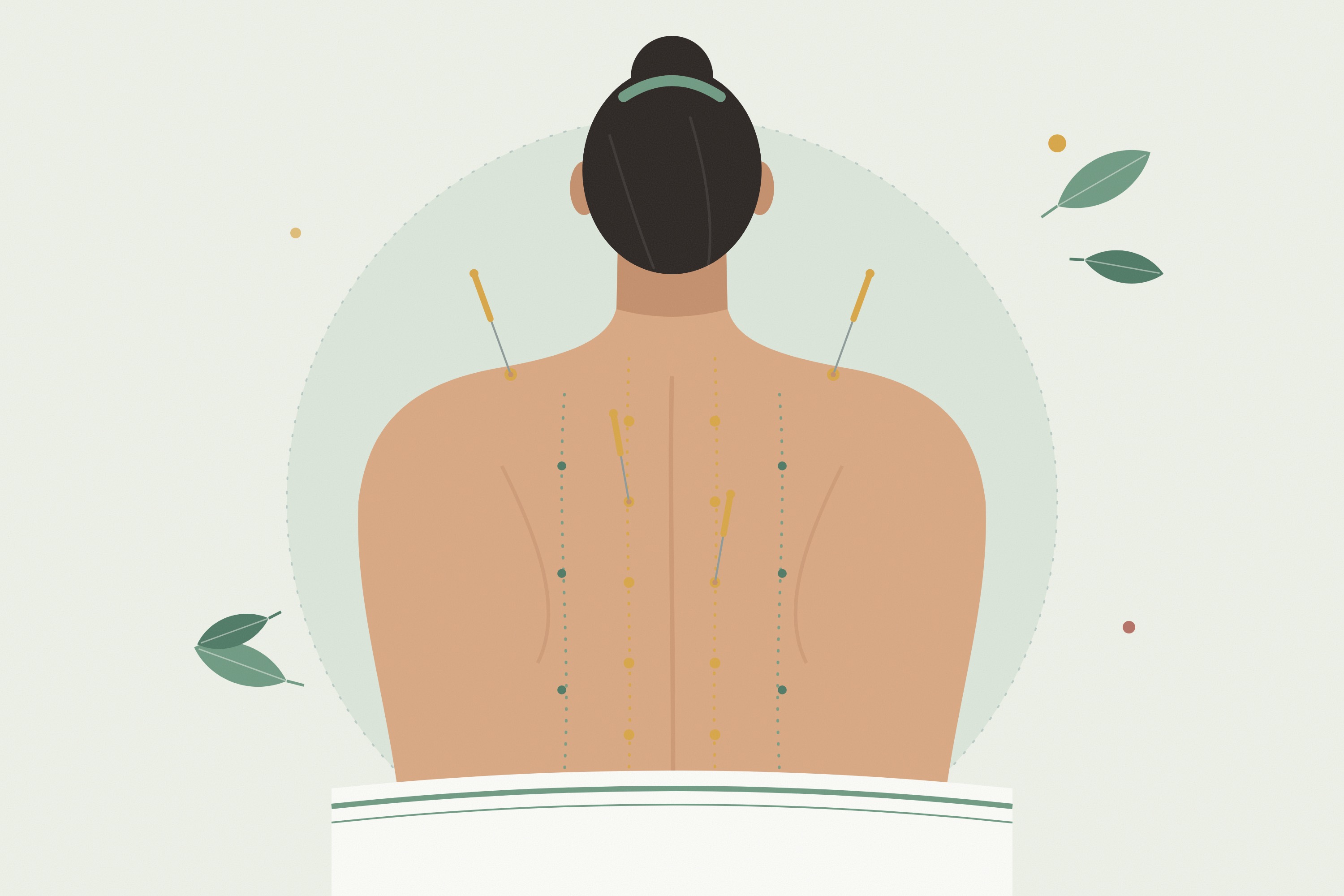 Acupuncture needles along meridian points on the back
