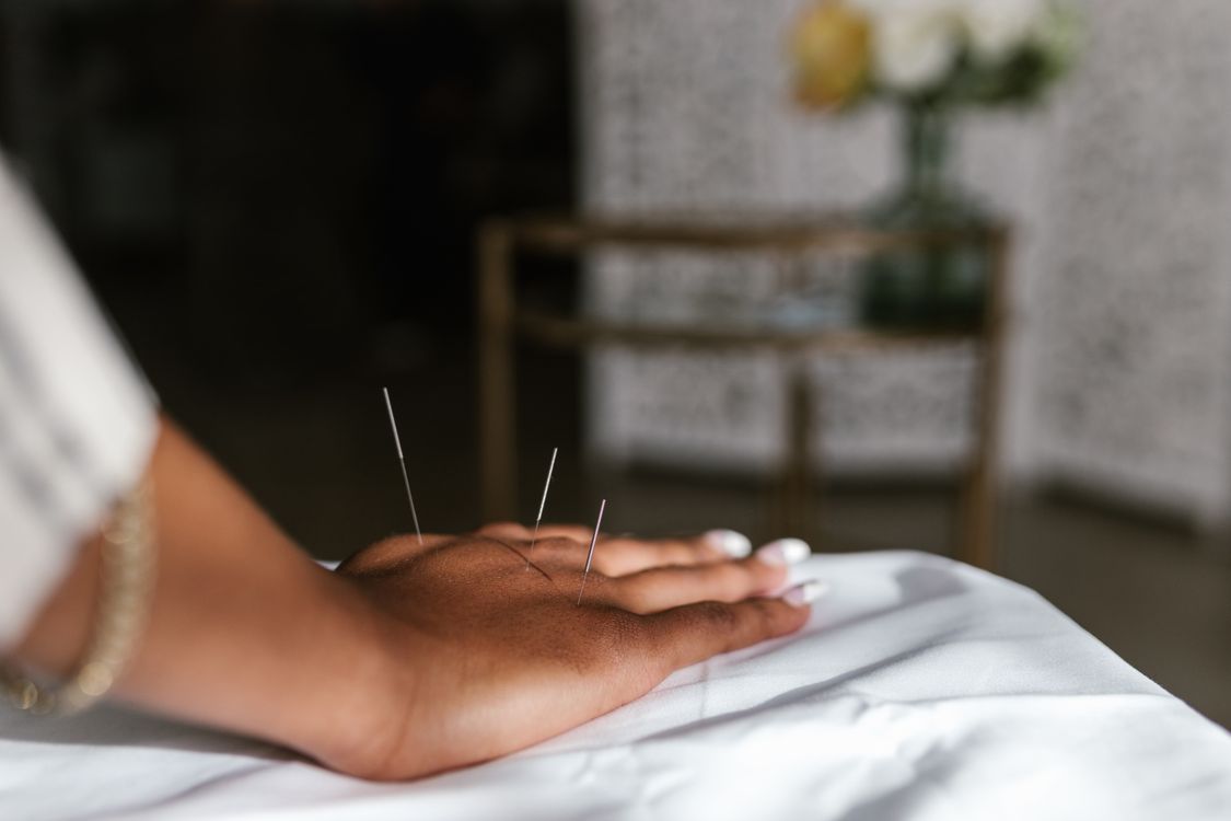 Patient receiving an acupuncture treatment session