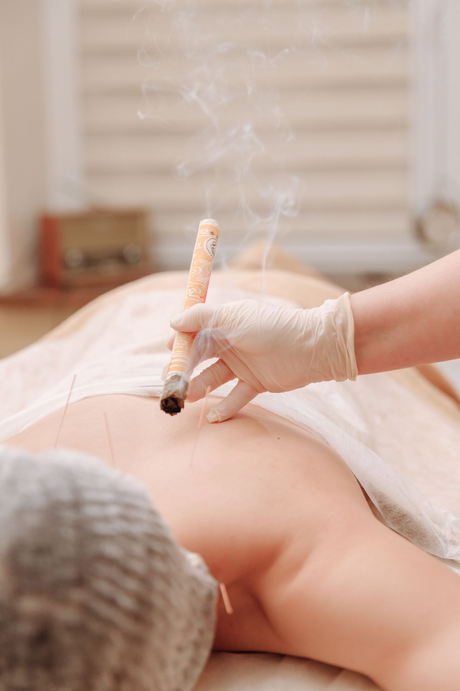 Practitioner holding a lit moxa stick during moxibustion therapy